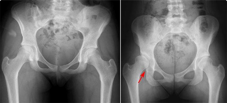 Teenager with right flank pain, Pediatric Radiology Case, Pediatric Imaging