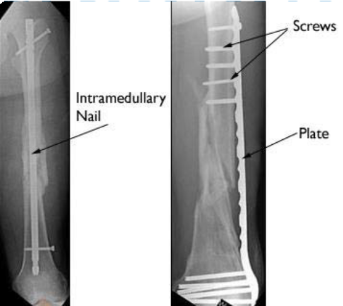 JCM | Free Full-Text | Perioperative Radiographic Predictors of Non-Union  in Infra-Isthmal Femoral Shaft Fractures after Antegrade Intramedullary  Nailing: A Case–Control Study