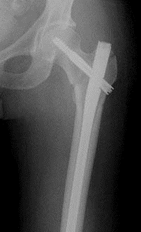 Intertrochanteric Fracture Repair 