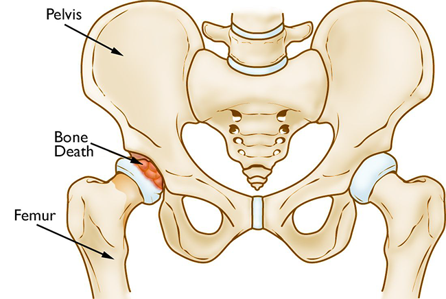 osteonecrosis