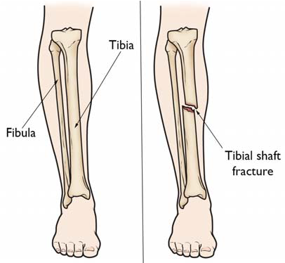 Anatomía de la espinilla