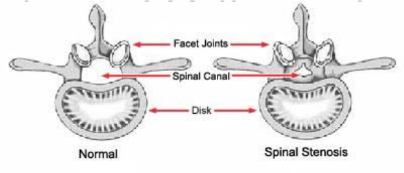 Lumbar Spinal Stenosis