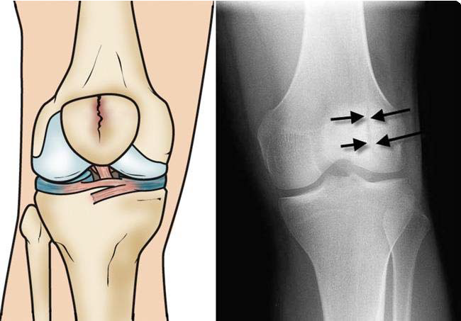 Fractura estable