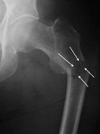 Subtrochanteric Fracture