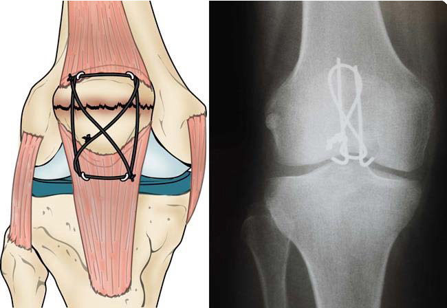 Tratamiento de fracturas transversales