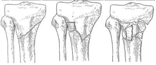 Shinbone Fracture