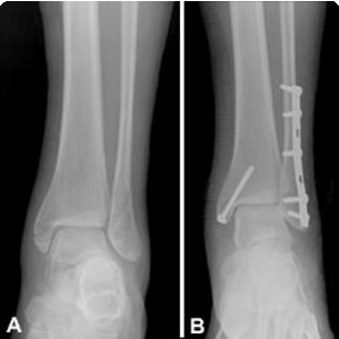Ankle Fracture  Boston Medical Center