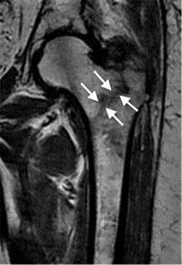 Broken Hip MRI