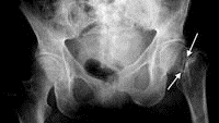 Radiografía de fractura de cadera