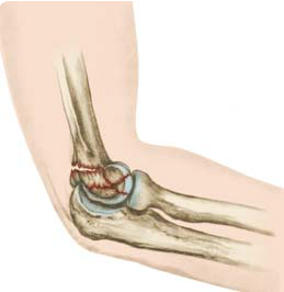 Distal Humerus Break