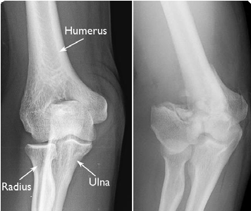 Distal Humerus Fracture X-Ray
