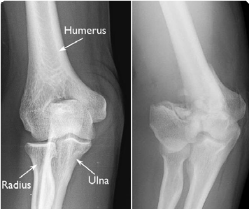 Radiografía de fractura de húmero distal