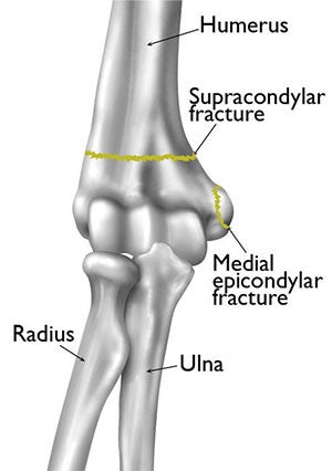 Elbow Fracture