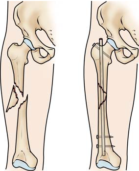 Femur Intramedullary Nailing