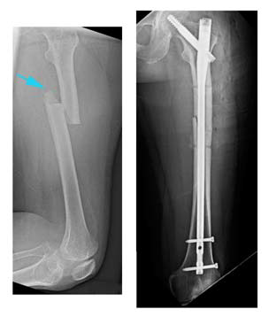 Femur Shaft Fracture Treatment | Boston Medical Center