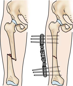 Femur Shaft Fracture External Fixation