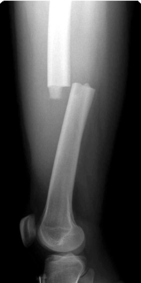 Femur Shaft X-Ray