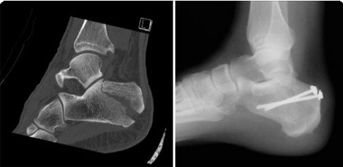 Heel Fracture