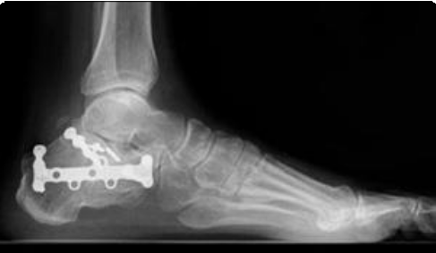 Best shoe hotsell after calcaneal fracture