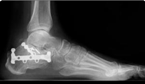 A 15-year-old male patient with a right calcaneus fracture underwent... |  Download Scientific Diagram