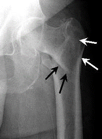 Intertrochanteric Fracture