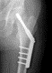 Intracapsular fracture Repair 