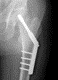 Reparación de fracturas intracapsulares