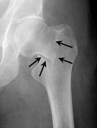 Intracapsular Fracture