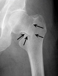 Fractura intracapsular