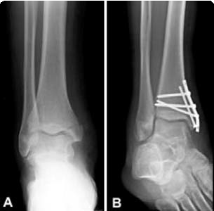 Ankle Fracture  Boston Medical Center