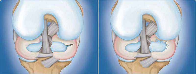 Meniscus Tear: (Left) Radial tear. (Right) Degenerative tear.