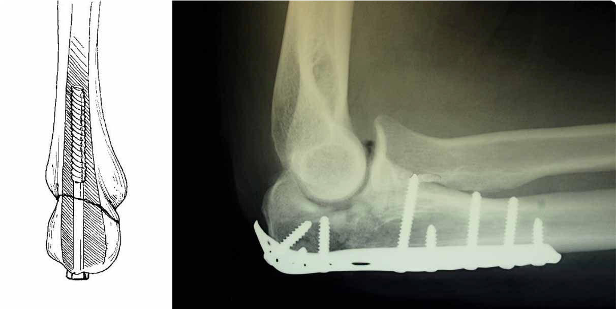 olecranon internal fixation