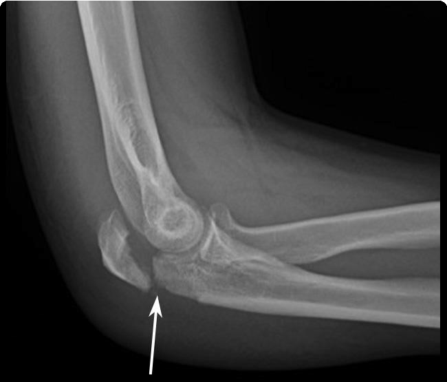 Elbow (Olecranon) Fracture Diagnosis | Boston Medical Center