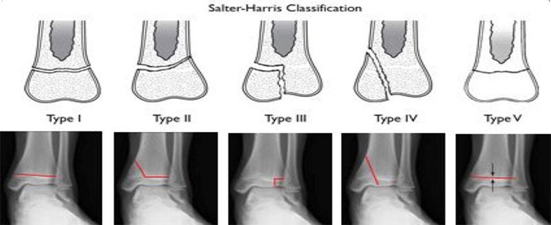 Salter Harris I and II Fractures