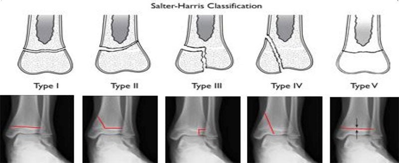 Fractured Ankle - Ankle - Conditions - Musculoskeletal - What We Treat 