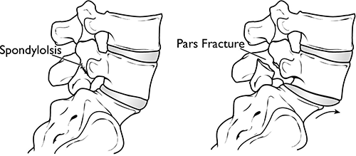 spondylosis