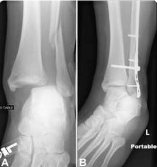 Syndesmotic Injury