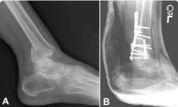 Fractura trimaleolar