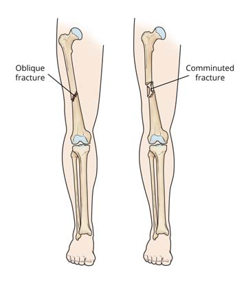 Femur Shaft Fractures