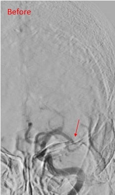 Arteria cerebral media izquierda ocluida (flecha)