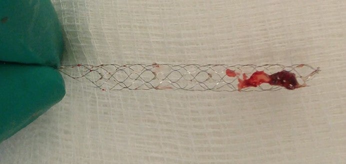 Stent retriever with clot