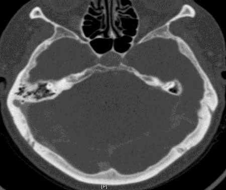 Sigmoid Sinus Diverticulum