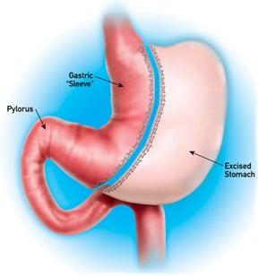 Este es un diagrama de la gastrectomía en manga o del procedimiento de manga gástrica, una opción de cirugía para bajar de peso.
