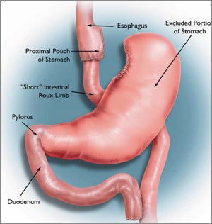 Este es un diagrama del procedimiento de bypass gástrico, una opción de cirugía para bajar de peso. Su estómago se hará más pequeño al engraparlo y dividirlo en dos compartimentos.