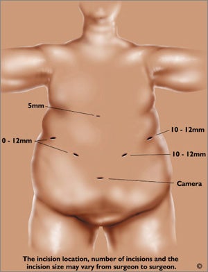 laparoscopic_surgery-bmc-THUMB