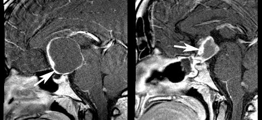 Cerebro de Taylor Parker, preoperatorio (izquierda) y posoperatorio