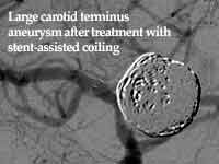 large carotid terminus aneurysm after treatment with stent-assisted coiling
