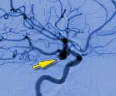 imaging of a brain aneurysm
