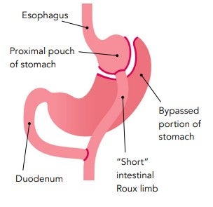 gastric bypass stomach