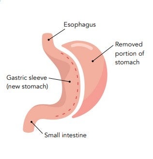 what a stomach looks like after a gastric sleeve